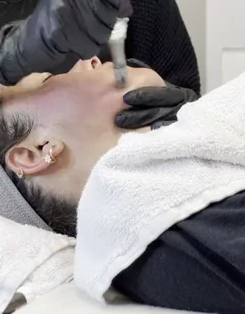 Microneedling at Aesthetics by Vero in Everett, MA