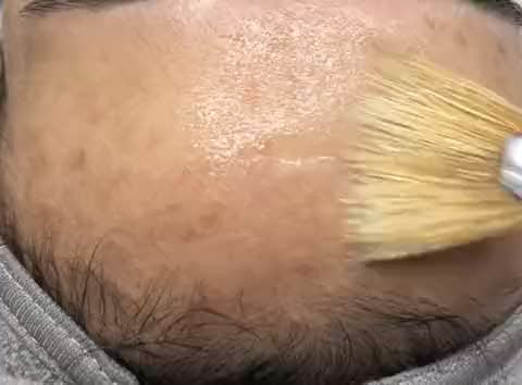 Chemical Peel at Aesthetics by Vero in Everett, MA